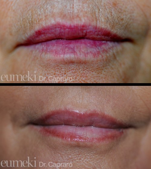 Caso 2 - Rimodellamento labbra con grasso e dermoabrasione - frontale