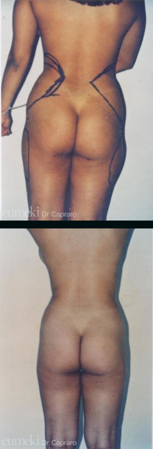 Caso 1 - Liposuzione liposcultura mastoplastica - posteriore