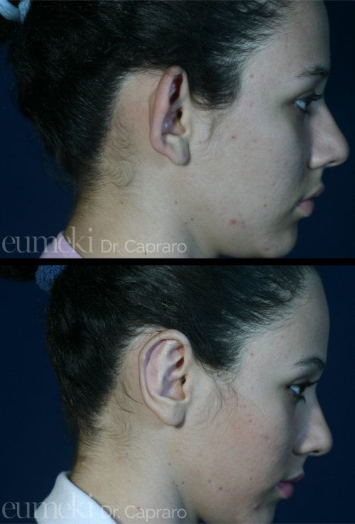 Plastica delle orecchie vista laterale primo caso