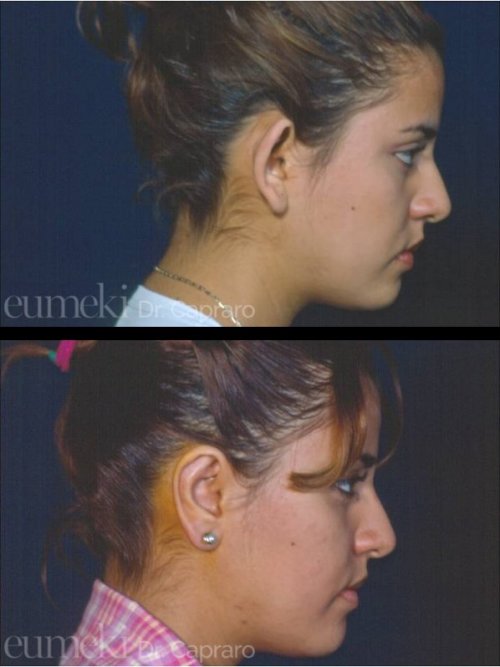 Plastica delle orecchie vista lato destro secondo caso