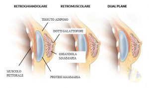 Posizionamento delle prostesi nel lifting del seno