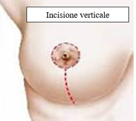 incisione verticale per riduzione volumetrica del seno