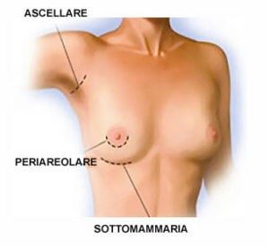 Tre possibili zone di incisione per l'inserimento delle protesi per l'aumento del seno