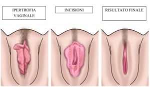 labioplastica